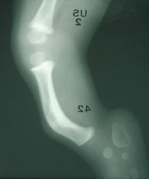 Fibular hemimelia X-ray
