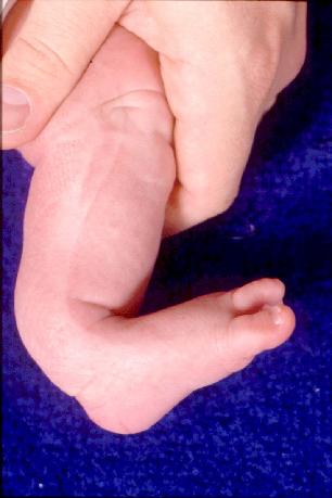 Calcaneovalgus foot