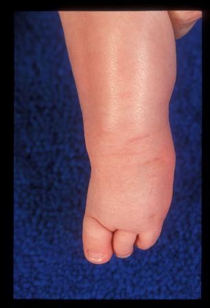 Fibular hemimelia foot