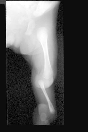 Tibial hemimelia X-ray